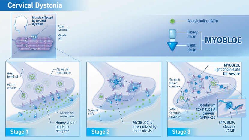Graphic showing the mechanism of action in stages for MYOBLOC in cervical dystonia
