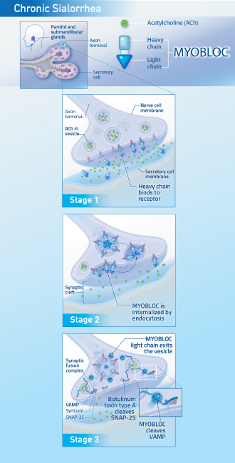 Graphic showing the mechanism of action stages for MYOBLOC in chronic sialorrhea