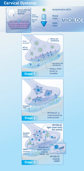 Graphic showing the mechanism of action in stages for MYOBLOC in cervical dystonia